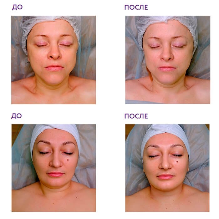 Набор карбокситерапии Aravia СО2 Anti-Age Set