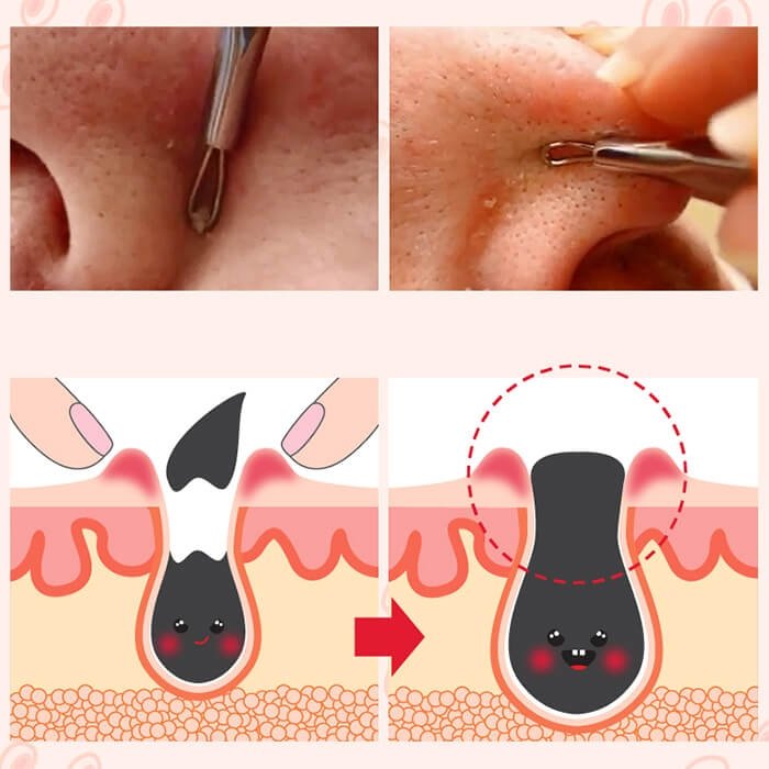 Набор от чёрных точек Nightingale Tako Pack Nose (5 уп.)