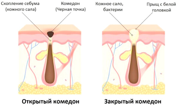 Что такое черные точки